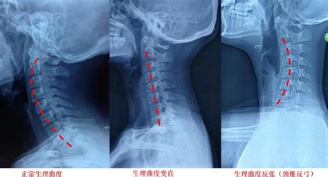 反弓|什么是颈椎“反弓”？一把尺就能告诉你颈椎好不好